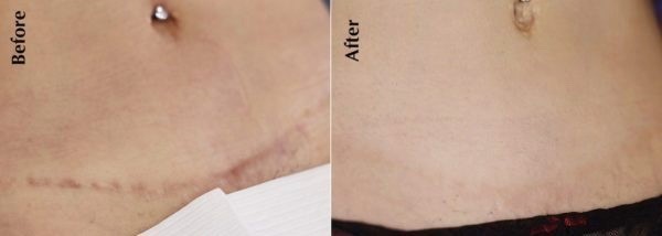 Keloid Tattoo When Scars Form Tattooing Over Keloids More